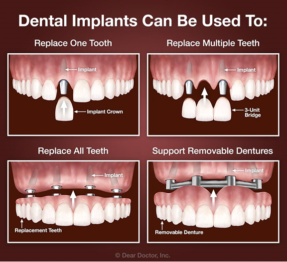 Is it better to have dentures or implants?