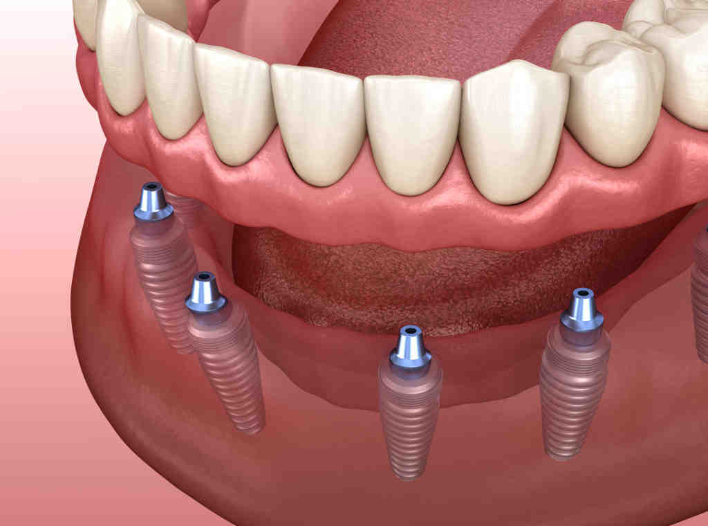 Is it better to leave dentures in or out at night?