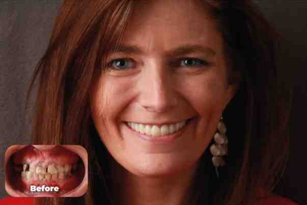 Is it common for dental implants to fall out?