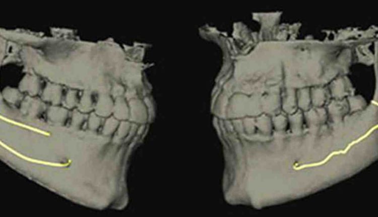 Is it normal for dental implant to ache