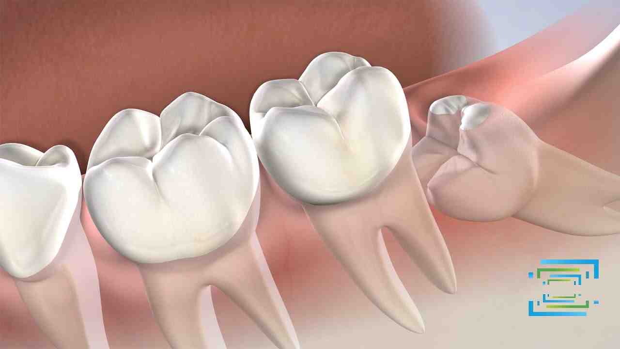 Is it normal for tooth implant to bleed?