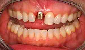 Is it painful having tooth implants?