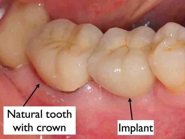 Is it painful to get implants?