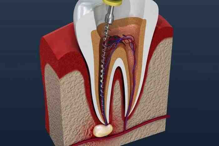 Is root canal painful?