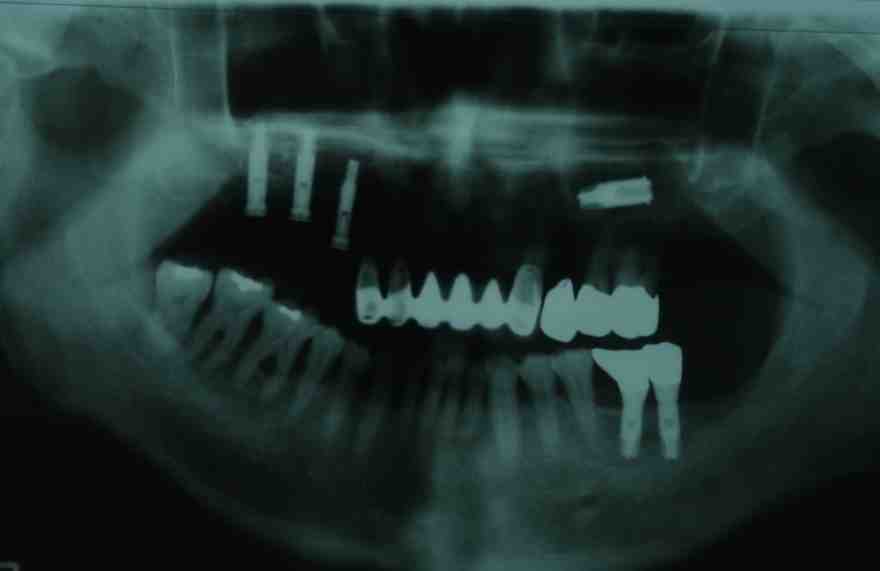 Is there a difference in quality of dental implants?