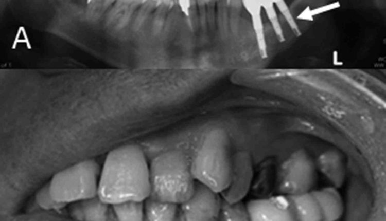 Is there a link between dental implants and cancer