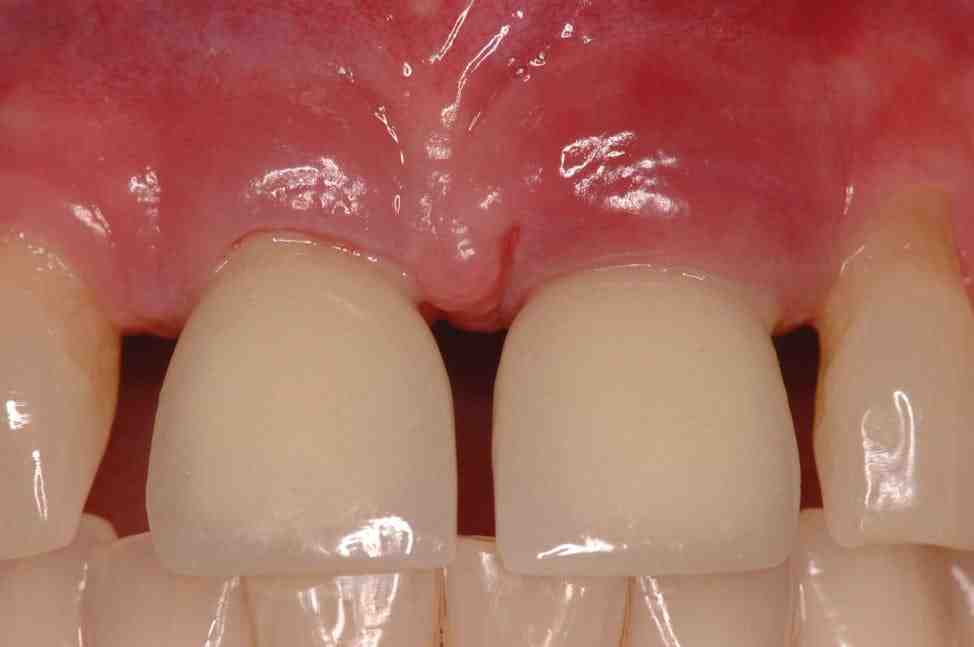Is water flossing good for implants?