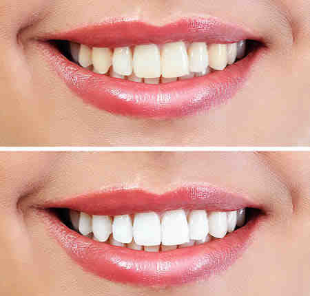 Most popular types of cosmetic dentistry