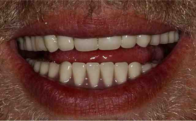 Pourquoi les vieux ont des dentiers ?