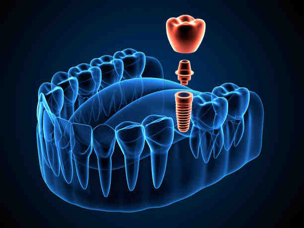 Should I take antibiotics after dental implant?