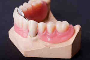 Should elderly people get implants?
