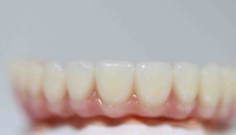Should i get a dental implant or a bridge