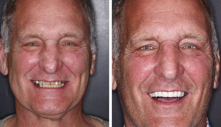 Shouldyou wear temporary denture at night after dental implants?