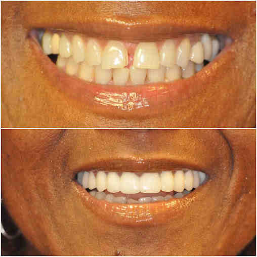 What age should you get veneers?