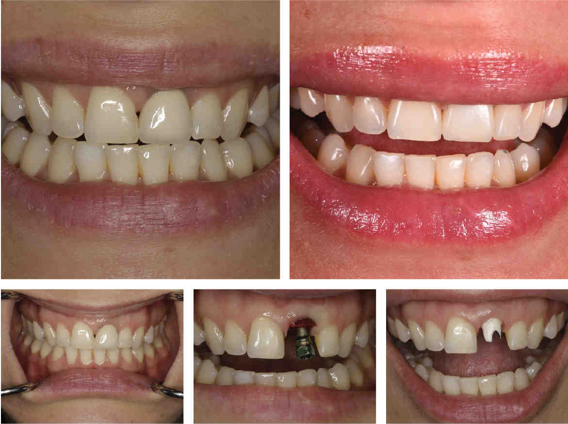 What are alternatives to dental implants?