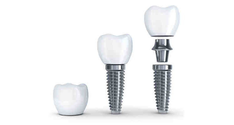 What are dental implant