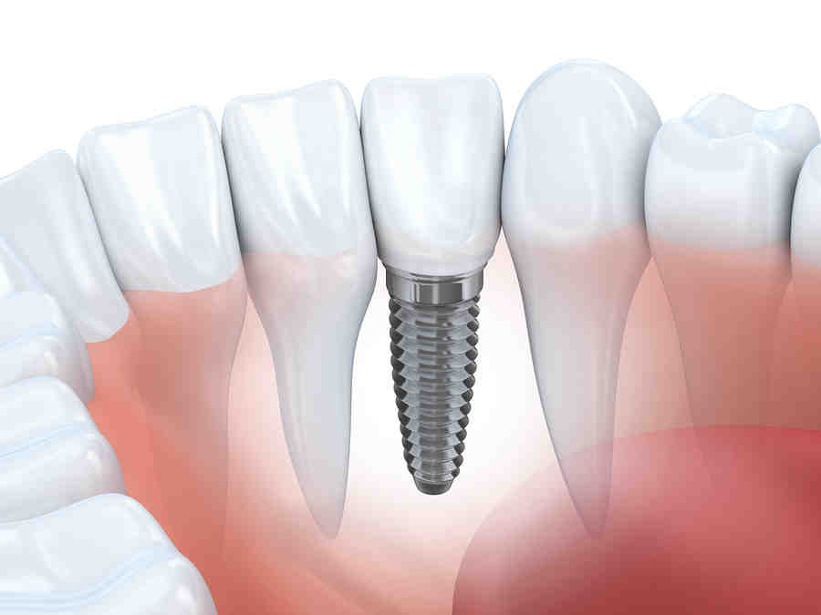 What are four types of dental implants?