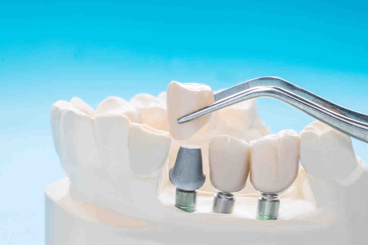 What are limitations with dental implants?