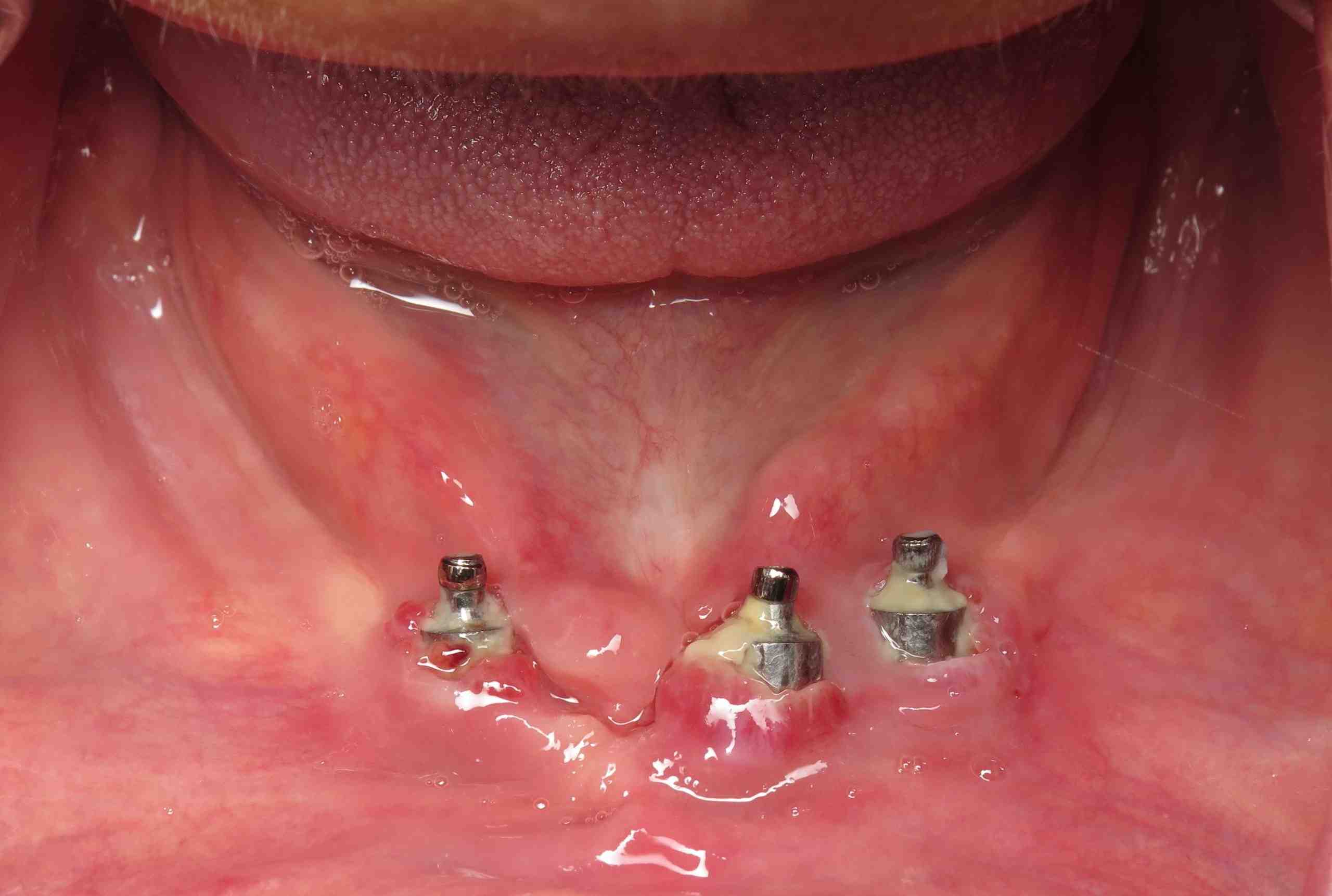 What are limitations with dental implants?