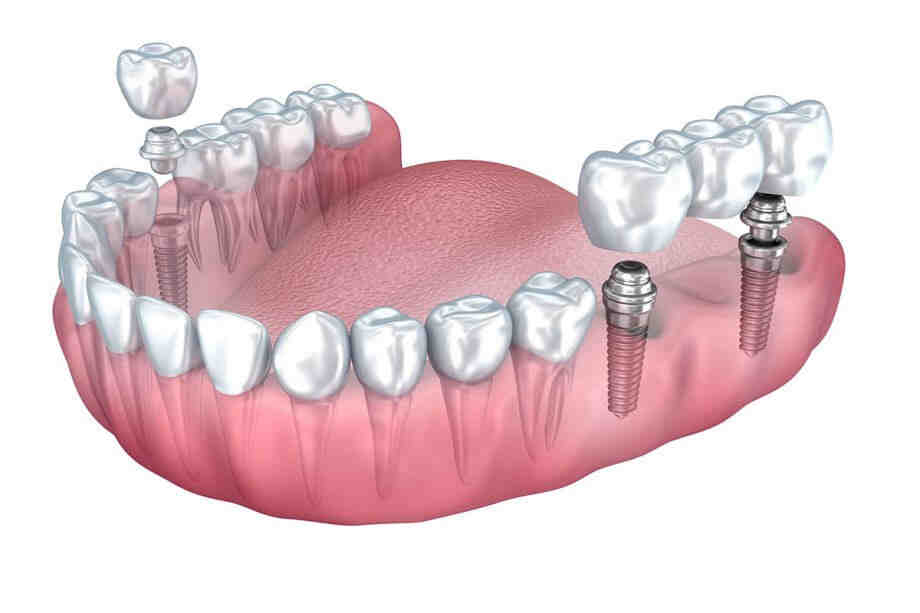 What are permanent fake teeth called?