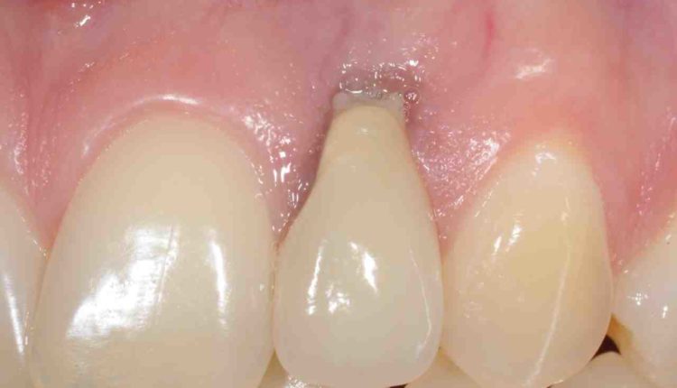 What are some complications from dental implants