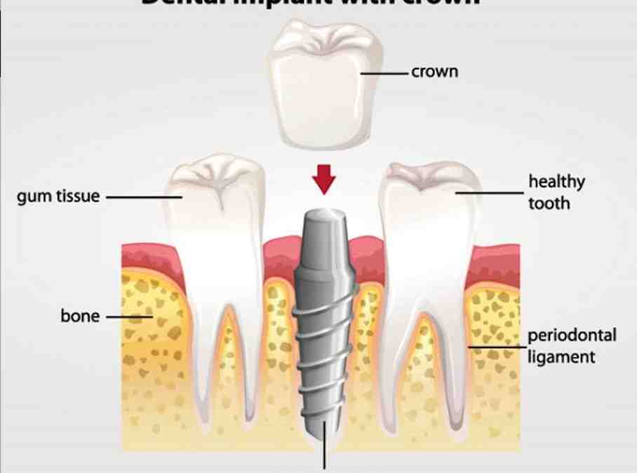 What are standard dental implants?