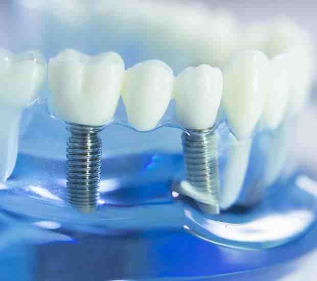 What are standard dental implants?