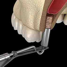 What are the 2 main types of dental implants today?