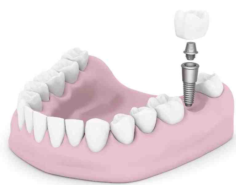 What are the 3 types of dental implants?