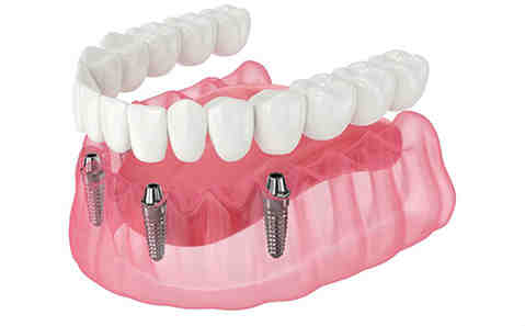 What are the 3 types of dental implants?