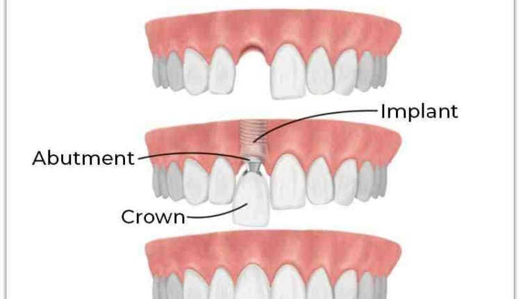 What are the best dental implants