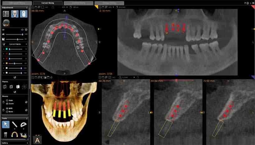 What are the different types of dental X-ray techniques?