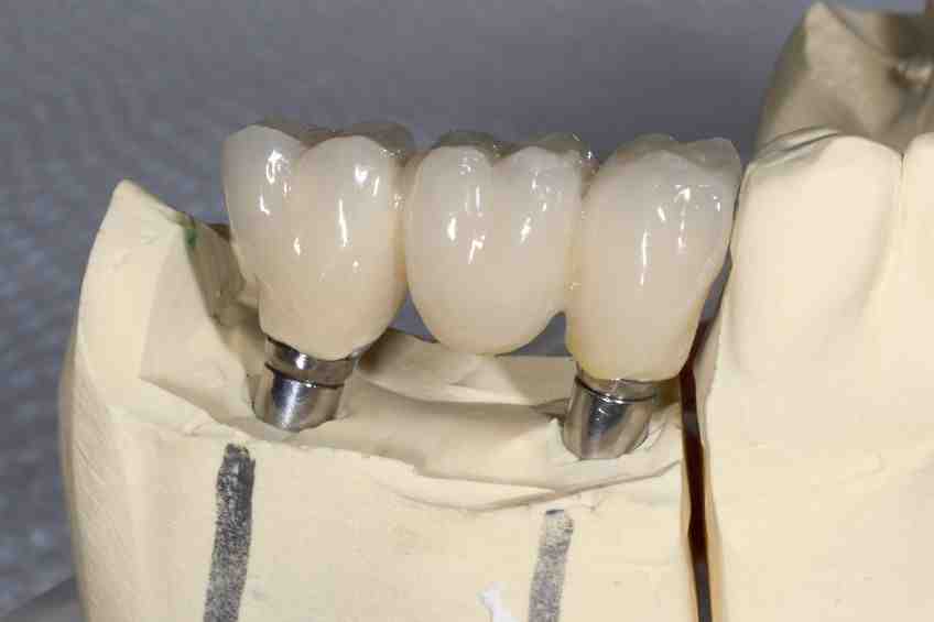What are the different types of prosthesis?