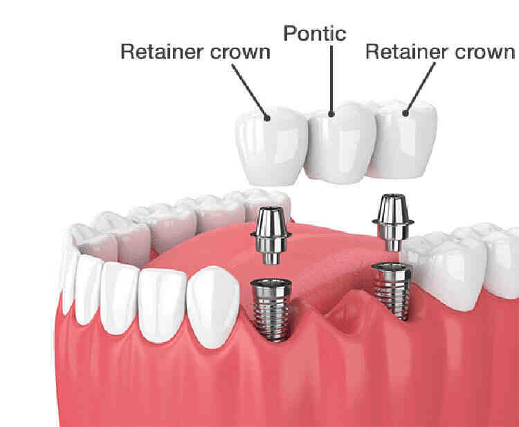 What are the disadvantages of dental implants?