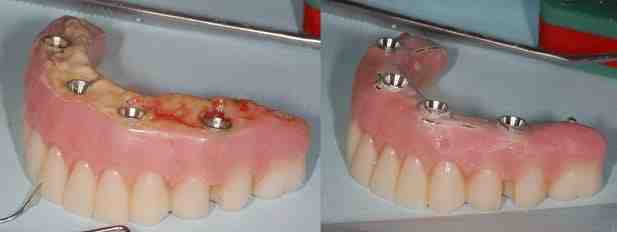 What are the disadvantages of dental implants?