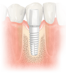 What are the disadvantages of titanium?