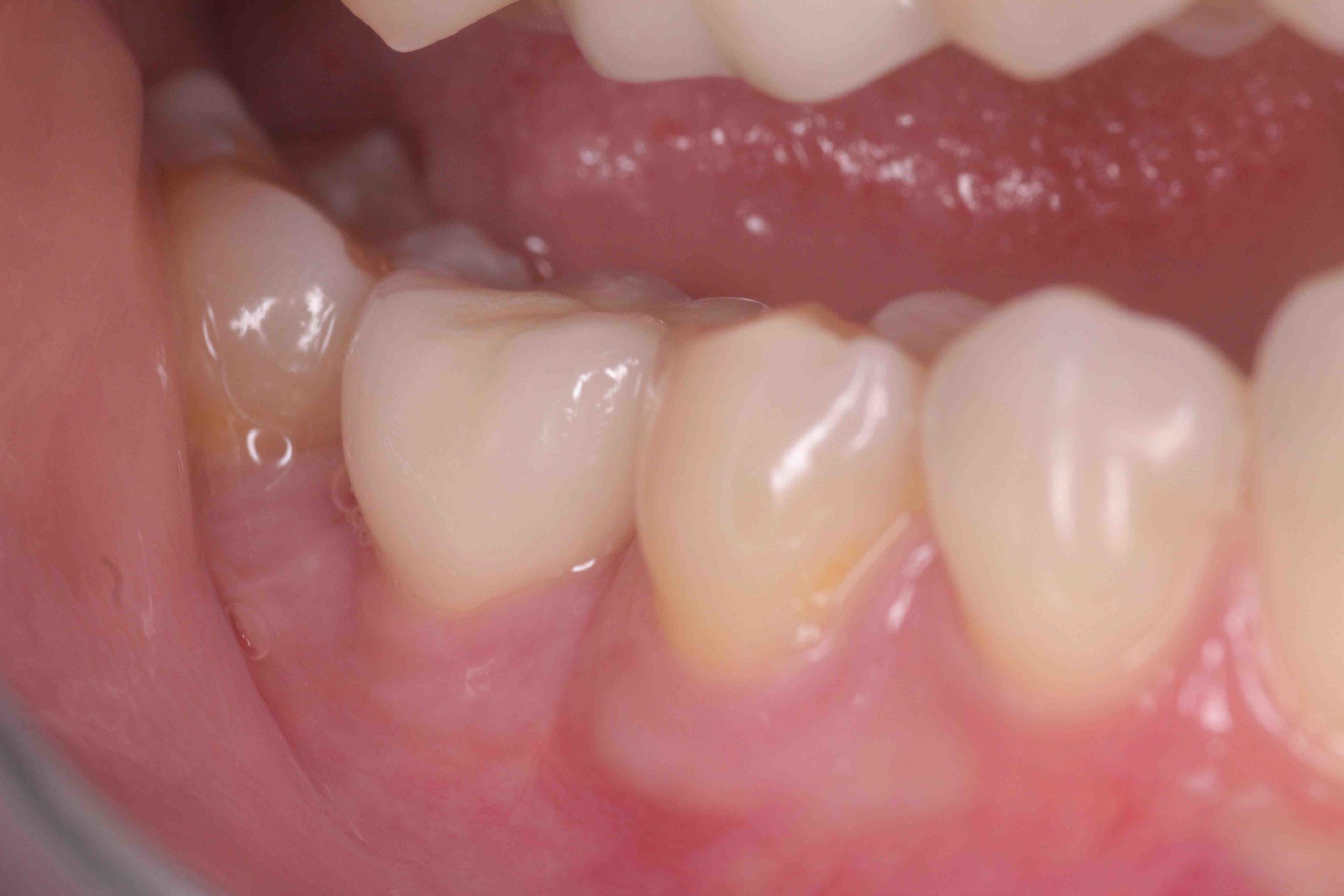 What are the long term effects of dental implants?
