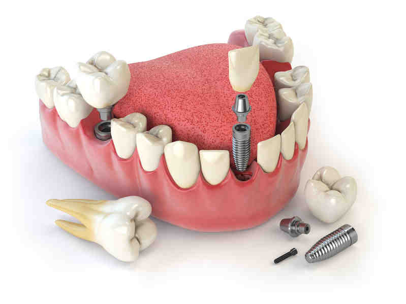What are the most common types of dental implants?