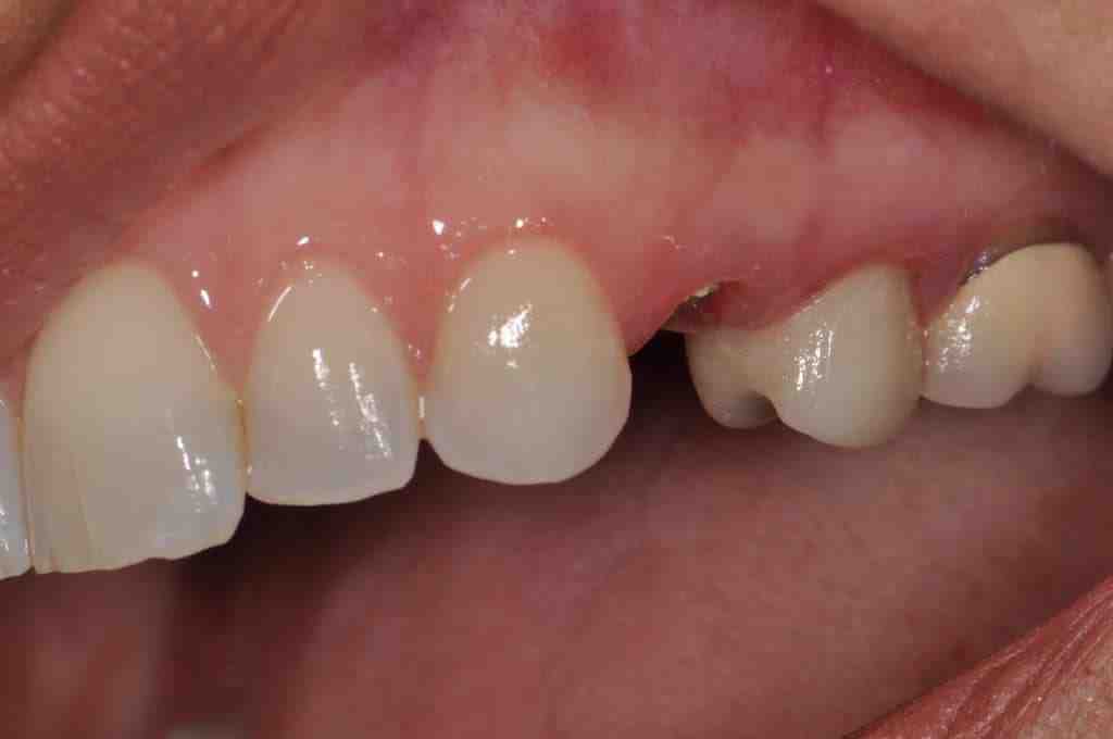 What are the negatives of dental implants?