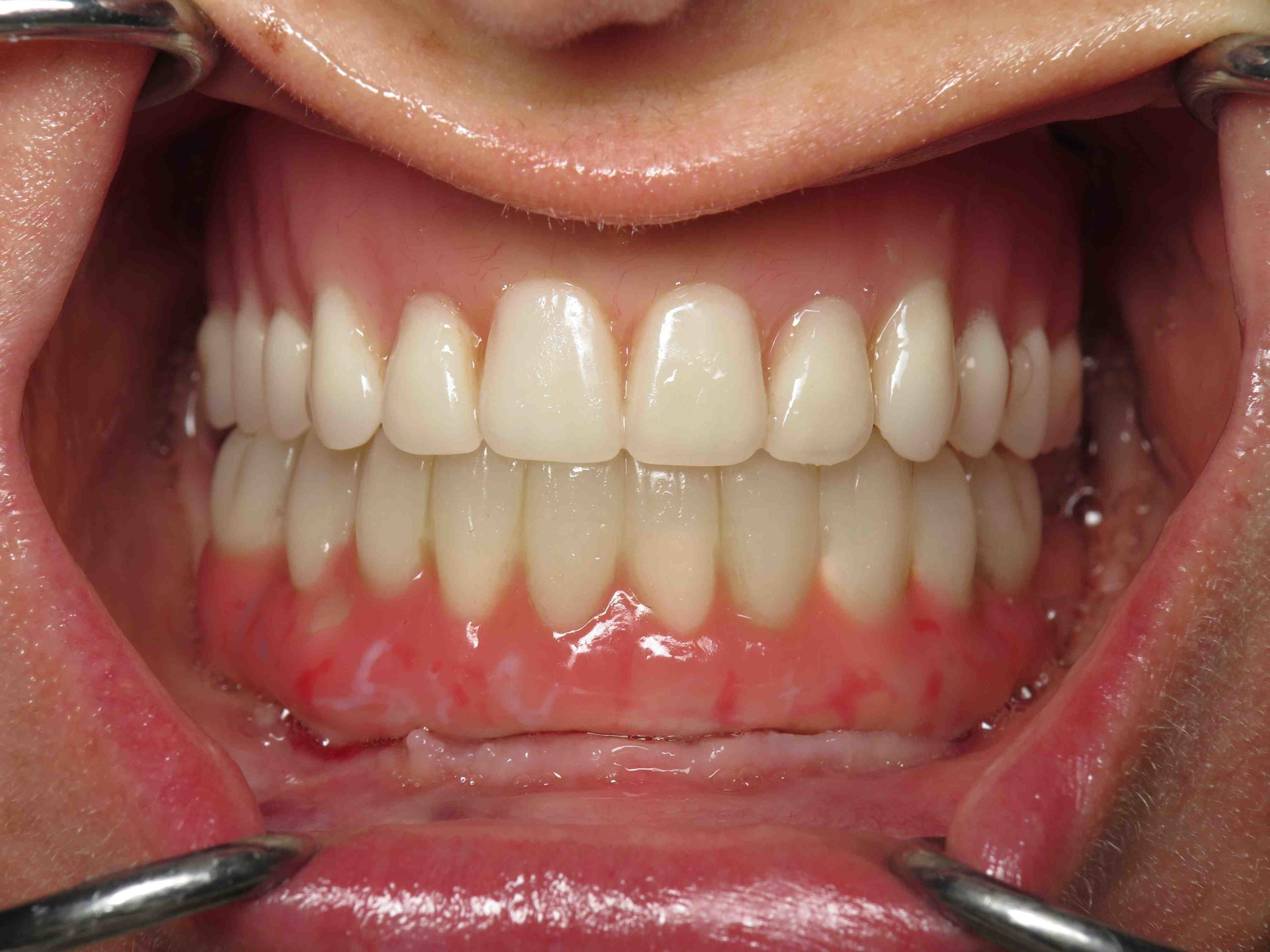 What are the parts of an implant called?