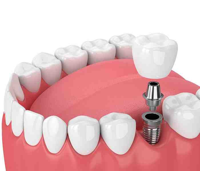 What are the pros and cons of denture implants?