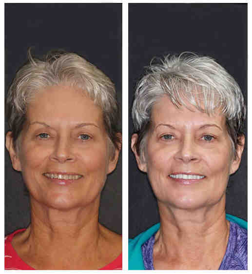 What are the risks associated with lasers?