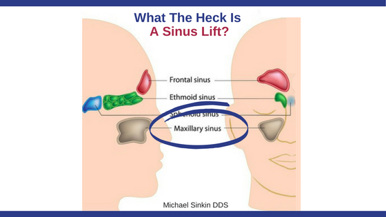 What are the risks of a sinus lift?