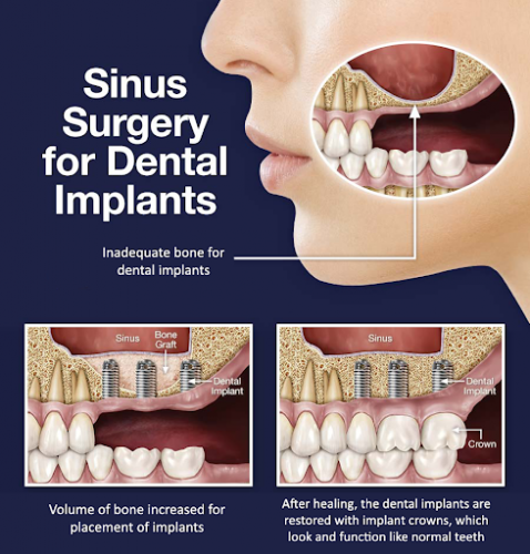 What are the signs of a failed dental bone graft?