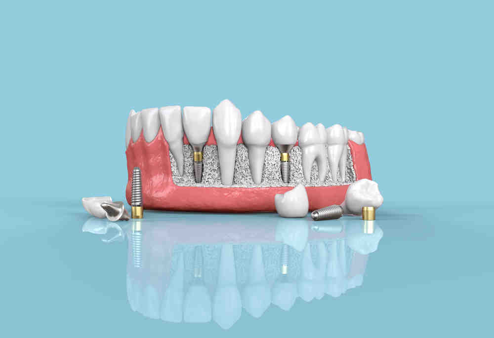 What are the signs of a failed dental bone graft?