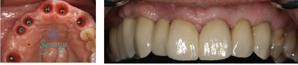 What are the signs of a failed dental bone graft?