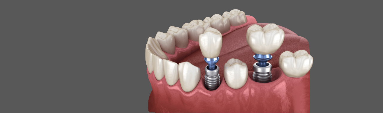 What are the stages of a dental implant?