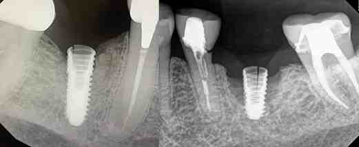 What are the stages of bone healing?