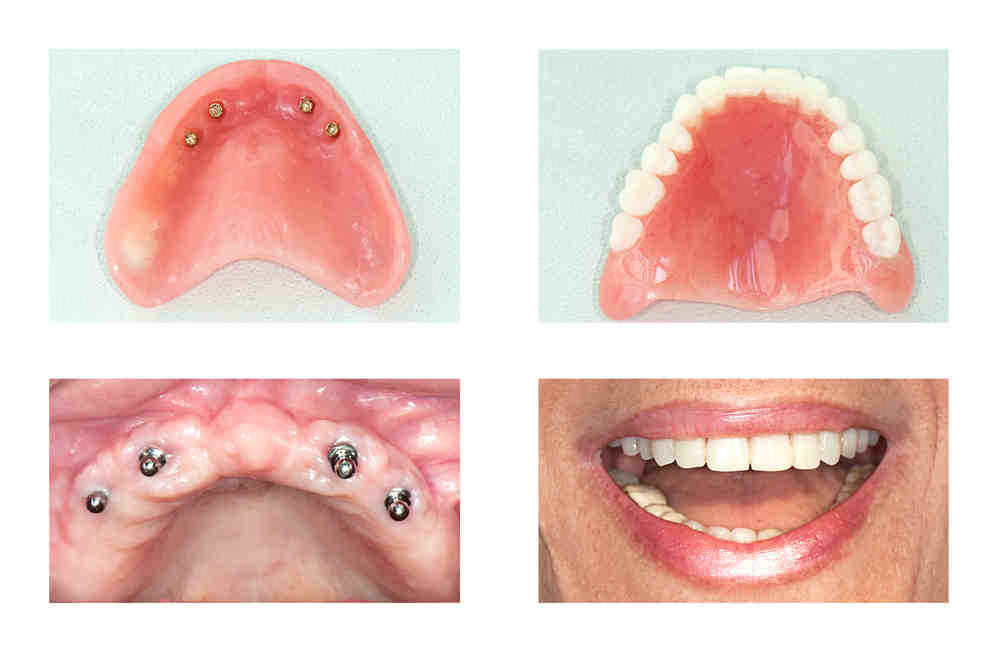 What are the steps in getting a dental implant?