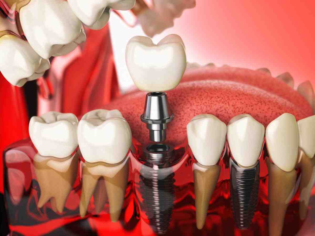 What are the strongest dental implants?